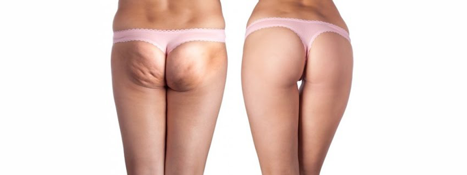 Flacidez, estrias e celulite no bumbum – Como resolver esse problema?